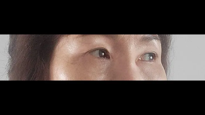 Sub-brow Lift, Lower Blepharoplasty (Aging Eye Rejuvenation) — RE&RE PLASTIC SURGERY 3