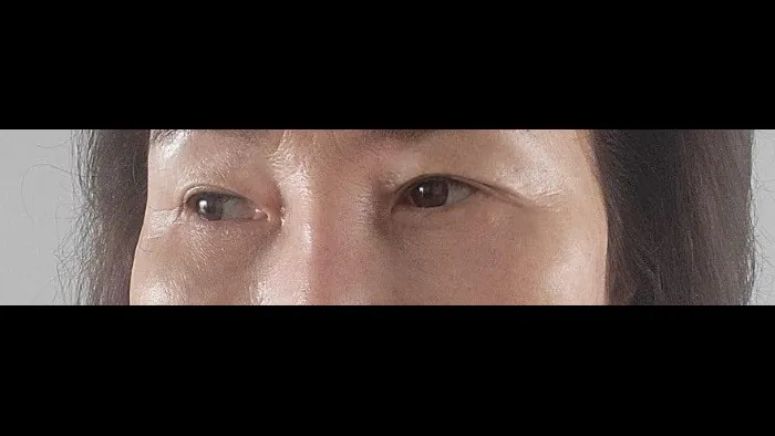 Sub-brow Lift, Lower Blepharoplasty (Aging Eye Rejuvenation) — RE&RE PLASTIC SURGERY 4