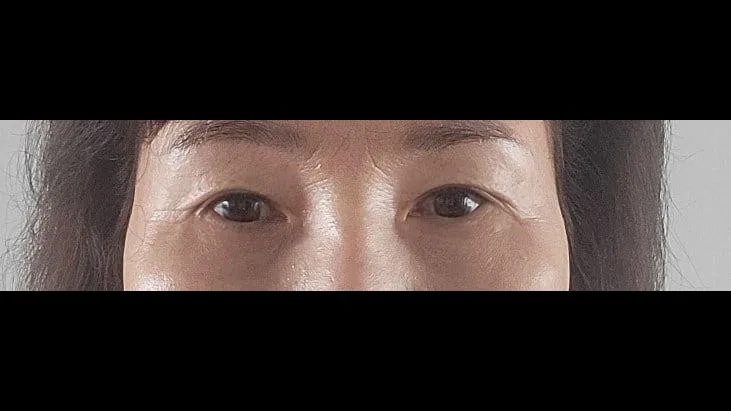 Sub-brow Lift, Lower Blepharoplasty (Aging Eye Rejuvenation) — RE&RE PLASTIC SURGERY 5