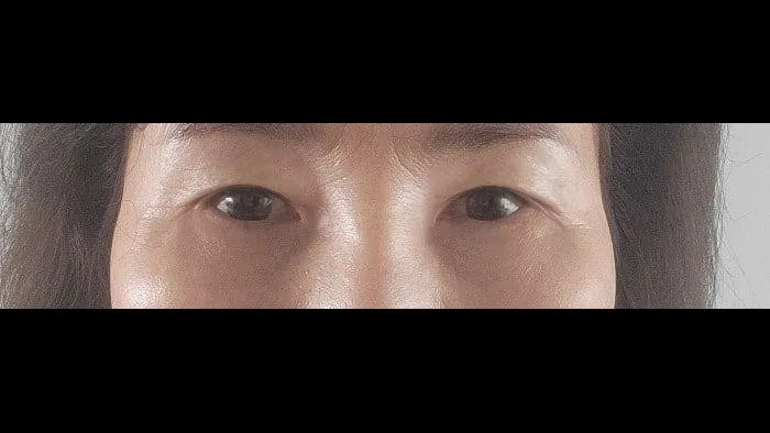Sub-brow Lift, Lower Blepharoplasty (Aging Eye Rejuvenation) — RE&RE PLASTIC SURGERY 6