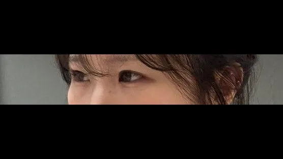 Incisional Double Eyelid Surgery, Ptosis Correction — RE&RE PLASTIC SURGERY 2