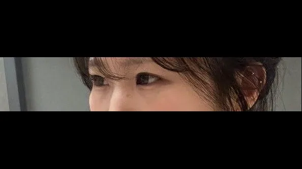 Incisional Double Eyelid Surgery, Ptosis Correction — RE&RE PLASTIC SURGERY 3