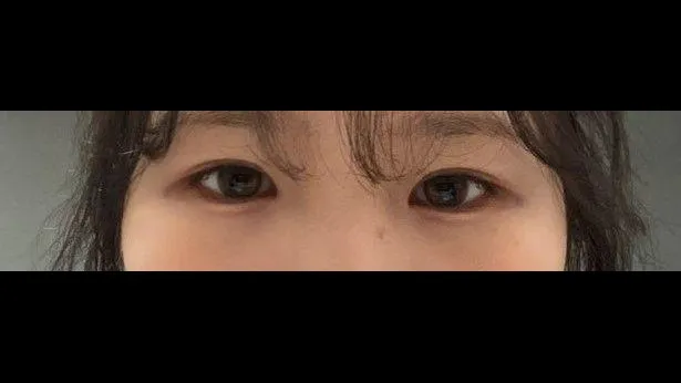 Incisional Double Eyelid Surgery, Ptosis Correction — RE&RE PLASTIC SURGERY 4