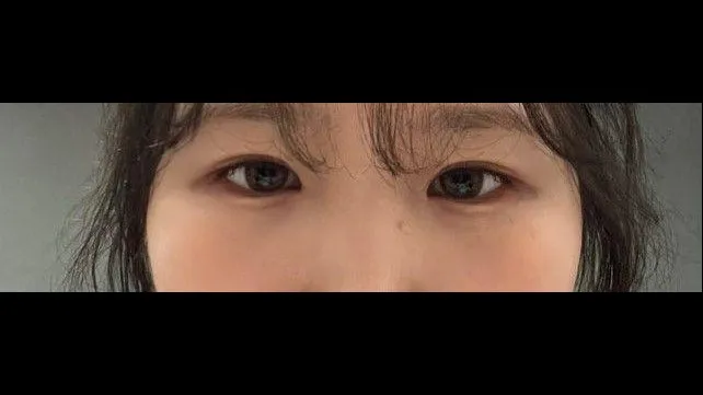 Incisional Double Eyelid Surgery, Ptosis Correction — RE&RE PLASTIC SURGERY 5