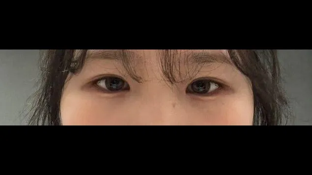 Incisional Double Eyelid Surgery, Ptosis Correction — RE&RE PLASTIC SURGERY 6