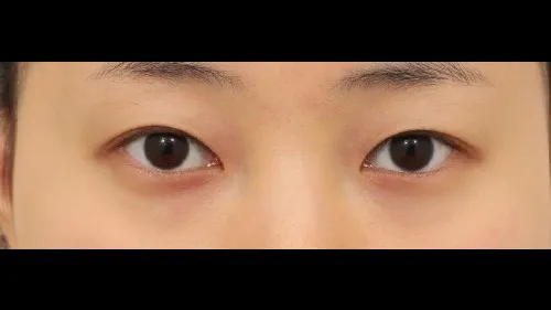 Natural Adhesion Double Eyelid Surgery, Lower Eyelid Fat Repositioning — RE&RE PLASTIC SURGERY 2