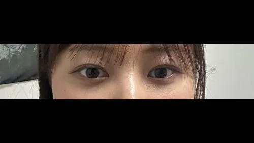 Natural Adhesion Double Eyelid Surgery, Lower Eyelid Fat Repositioning — RE&RE PLASTIC SURGERY 3