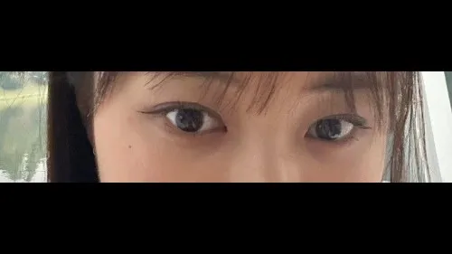 Natural Adhesion Double Eyelid Surgery, Lower Eyelid Fat Repositioning — RE&RE PLASTIC SURGERY 4