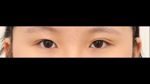 Natural Adhesion Double Eyelid Surgery, Ptosis Correction — RE&RE PLASTIC SURGERY 1