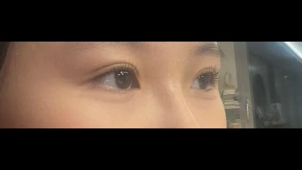 Natural Adhesion Double Eyelid Surgery, Ptosis Correction — RE&RE PLASTIC SURGERY 2