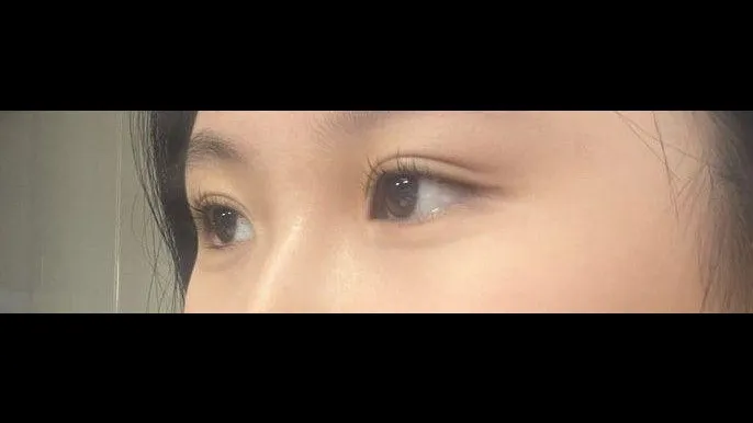 Natural Adhesion Double Eyelid Surgery, Ptosis Correction — RE&RE PLASTIC SURGERY 3