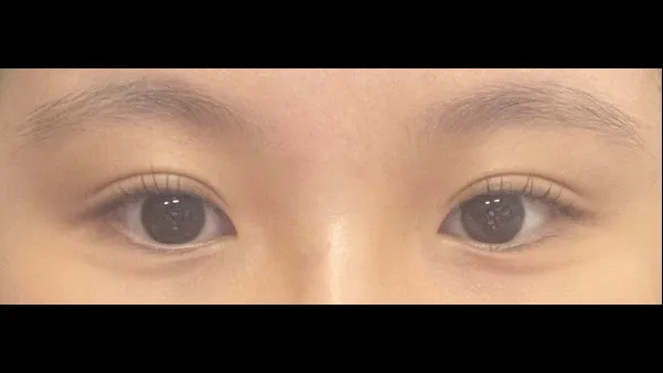Natural Adhesion Double Eyelid Surgery, Ptosis Correction — RE&RE PLASTIC SURGERY 4