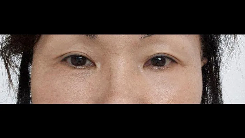 Sub-brow Lift, Lower Blepharoplasty (Aging Eye Rejuvenation) — RE&RE PLASTIC SURGERY 2
