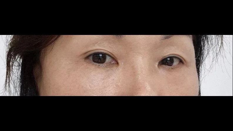 Sub-brow Lift, Lower Blepharoplasty (Aging Eye Rejuvenation) — RE&RE PLASTIC SURGERY 3