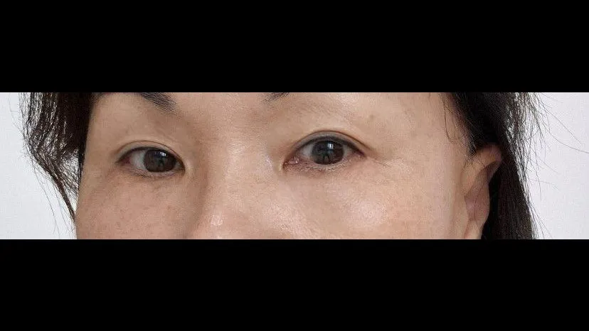 Sub-brow Lift, Lower Blepharoplasty (Aging Eye Rejuvenation) — RE&RE PLASTIC SURGERY 4