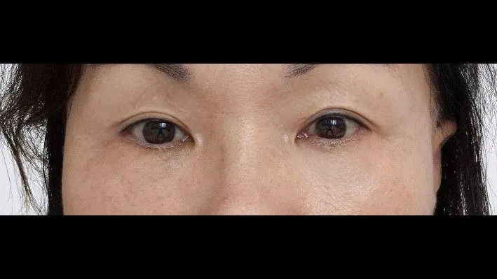 Sub-brow Lift, Lower Blepharoplasty (Aging Eye Rejuvenation) — RE&RE PLASTIC SURGERY 5