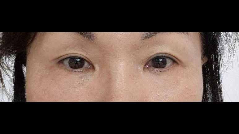 Sub-brow Lift, Lower Blepharoplasty (Aging Eye Rejuvenation) — RE&RE PLASTIC SURGERY 6