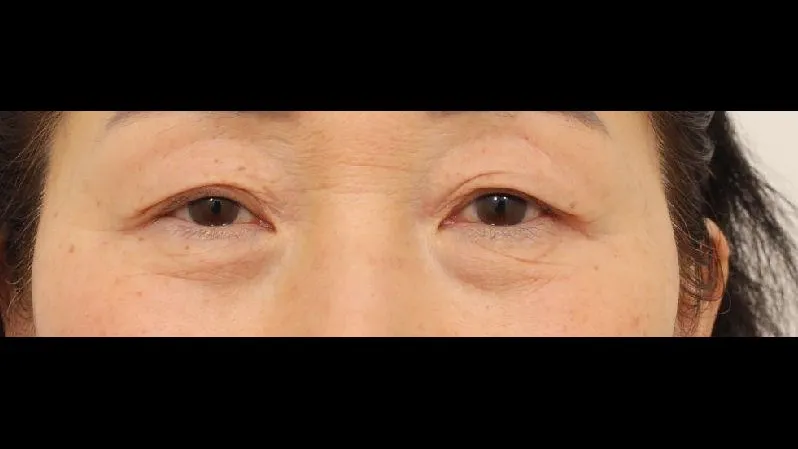 Sub-brow Lift, Lower Blepharoplasty (Aging Eye Rejuvenation), Ptosis Correction, Midface Lift — RE&RE PLASTIC SURGERY 1