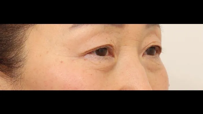 Sub-brow Lift, Lower Blepharoplasty (Aging Eye Rejuvenation), Ptosis Correction, Midface Lift — RE&RE PLASTIC SURGERY 2