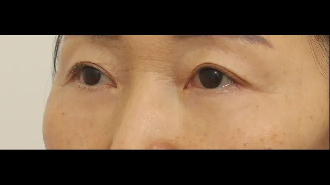 Sub-brow Lift, Lower Blepharoplasty (Aging Eye Rejuvenation), Ptosis Correction, Midface Lift — RE&RE PLASTIC SURGERY 3