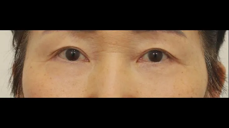 Sub-brow Lift, Lower Blepharoplasty (Aging Eye Rejuvenation), Ptosis Correction, Midface Lift — RE&RE PLASTIC SURGERY 4