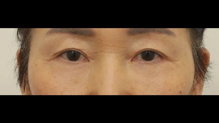 Sub-brow Lift, Lower Blepharoplasty (Aging Eye Rejuvenation), Ptosis Correction, Midface Lift — RE&RE PLASTIC SURGERY 5