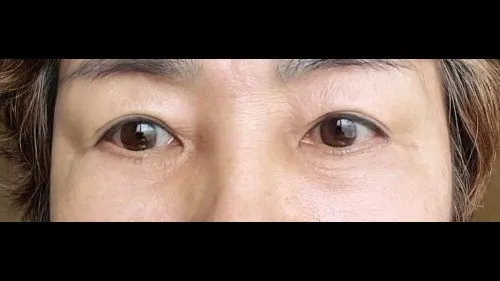 Natural Adhesion Double Eyelid Surgery, Lower Blepharoplasty (Aging Eye Rejuvenation), Midface Lift, Sub-brow Lift — RE&RE PLASTIC SURGERY 2