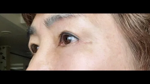 Natural Adhesion Double Eyelid Surgery, Lower Blepharoplasty (Aging Eye Rejuvenation), Midface Lift, Sub-brow Lift — RE&RE PLASTIC SURGERY 3