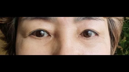 Natural Adhesion Double Eyelid Surgery, Lower Blepharoplasty (Aging Eye Rejuvenation), Midface Lift, Sub-brow Lift — RE&RE PLASTIC SURGERY 4