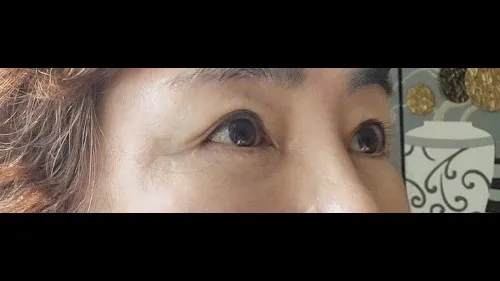 Natural Adhesion Double Eyelid Surgery, Lower Blepharoplasty (Aging Eye Rejuvenation), Midface Lift, Sub-brow Lift — RE&RE PLASTIC SURGERY 5