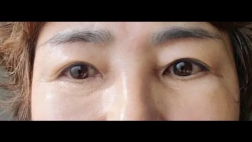 Natural Adhesion Double Eyelid Surgery, Lower Blepharoplasty (Aging Eye Rejuvenation), Midface Lift, Sub-brow Lift — RE&RE PLASTIC SURGERY 6