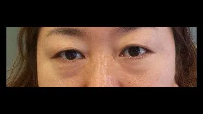 Sub-brow Lift, Lower Blepharoplasty (Aging Eye Rejuvenation), Midface Lift, Full-Face Thread lift 1