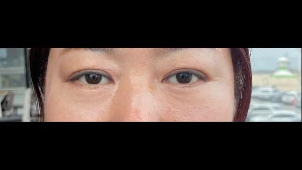 Sub-brow Lift, Lower Blepharoplasty (Aging Eye Rejuvenation), Midface Lift, Full-Face Thread lift 2