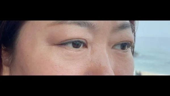 Sub-brow Lift, Lower Blepharoplasty (Aging Eye Rejuvenation), Midface Lift, Full-Face Thread lift — RE&RE PLASTIC SURGERY 3