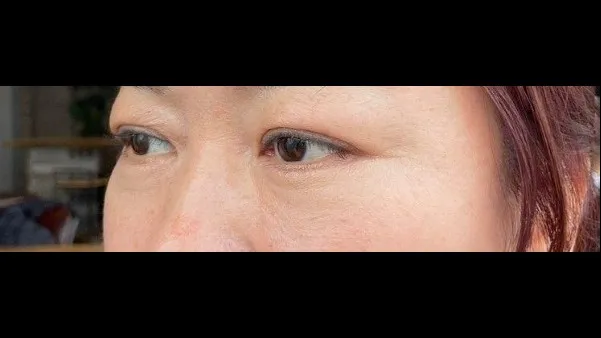 Sub-brow Lift, Lower Blepharoplasty (Aging Eye Rejuvenation), Midface Lift, Full-Face Thread lift — RE&RE PLASTIC SURGERY 4