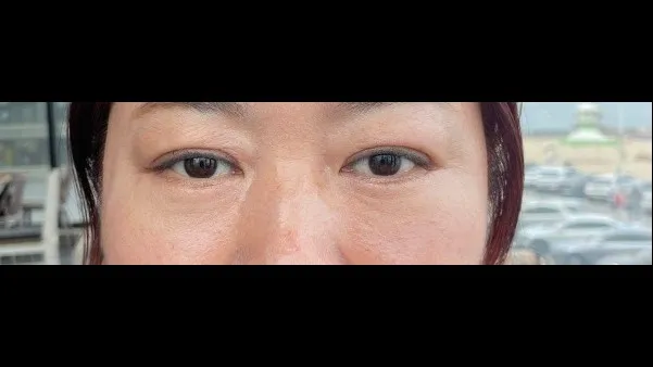 Sub-brow Lift, Lower Blepharoplasty (Aging Eye Rejuvenation), Midface Lift, Full-Face Thread lift — RE&RE PLASTIC SURGERY 5