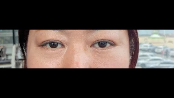 Sub-brow Lift, Lower Blepharoplasty (Aging Eye Rejuvenation), Midface Lift, Full-Face Thread lift — RE&RE PLASTIC SURGERY 6