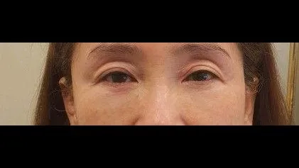 Sub-brow Lift, Ptosis Correction, Full-Face Thread lift 1
