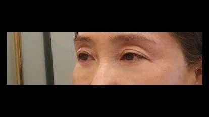 Sub-brow Lift, Ptosis Correction, Full-Face Thread lift — RE&RE PLASTIC SURGERY 2