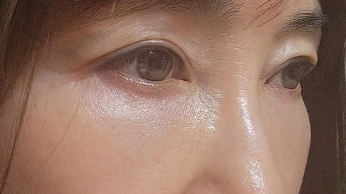 Sub-brow Lift, Ptosis Correction, Full-Face Thread lift — RE&RE PLASTIC SURGERY 3