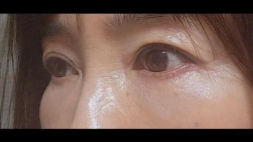 Sub-brow Lift, Ptosis Correction, Full-Face Thread lift — RE&RE PLASTIC SURGERY 4