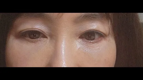Sub-brow Lift, Ptosis Correction, Full-Face Thread lift — RE&RE PLASTIC SURGERY 6