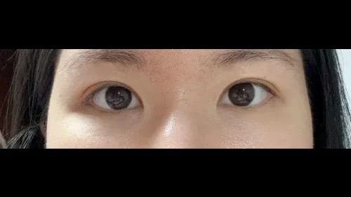 Incisional Double Eyelid Surgery — RE&RE PLASTIC SURGERY 2