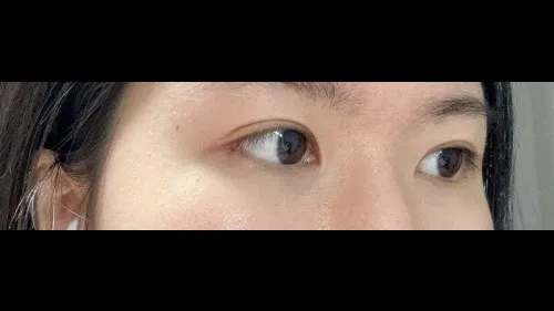 Incisional Double Eyelid Surgery — RE&RE PLASTIC SURGERY 3
