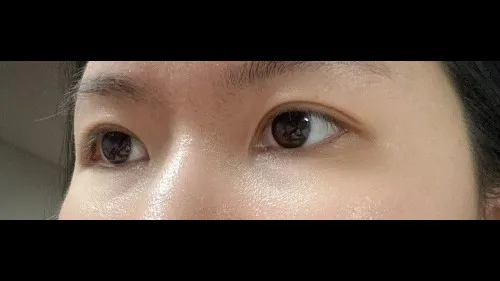 Incisional Double Eyelid Surgery — RE&RE PLASTIC SURGERY 4