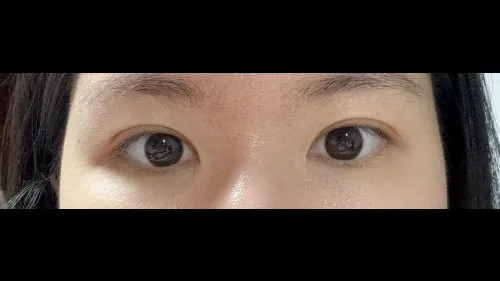 Incisional Double Eyelid Surgery — RE&RE PLASTIC SURGERY 5