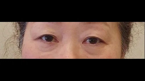 Sub-brow Lift, Ptosis Correction — RE&RE PLASTIC SURGERY 1