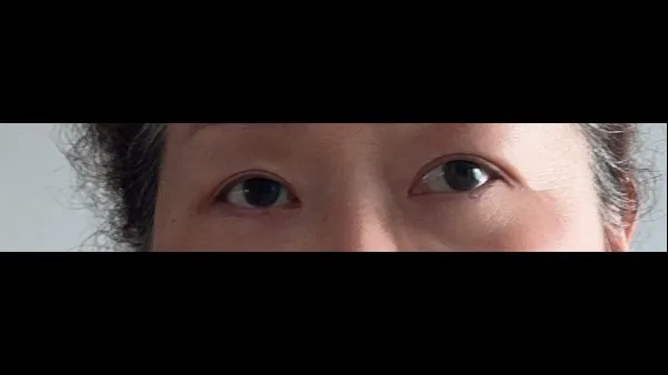 Sub-brow Lift, Ptosis Correction — RE&RE PLASTIC SURGERY 2
