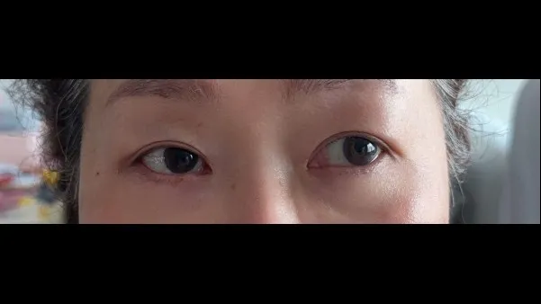 Sub-brow Lift, Ptosis Correction — RE&RE PLASTIC SURGERY 3