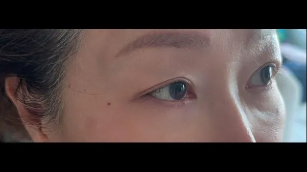 Sub-brow Lift, Ptosis Correction — RE&RE PLASTIC SURGERY 4